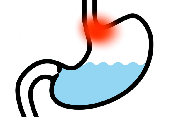 reflux reflux